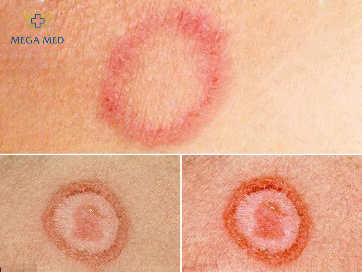 HÌNH ẢNH SĂNG GIANG MAI GIAI ĐOẠN 1 LÀ VẾT LOÉT TRÒN BẦU DỤC BỜ RÕ NỀN CỨNG