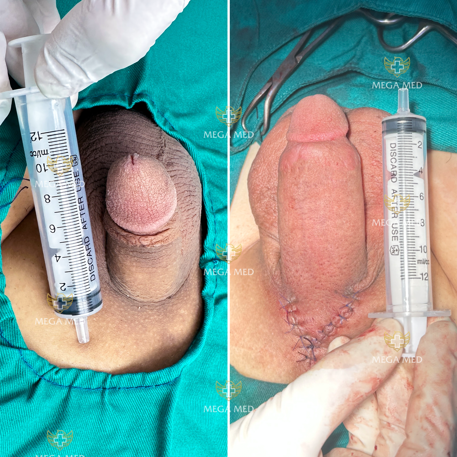CÓ NÊN PHẪU THUẬT TĂNG KÍCH THƯỚC CẬU NHỎ
