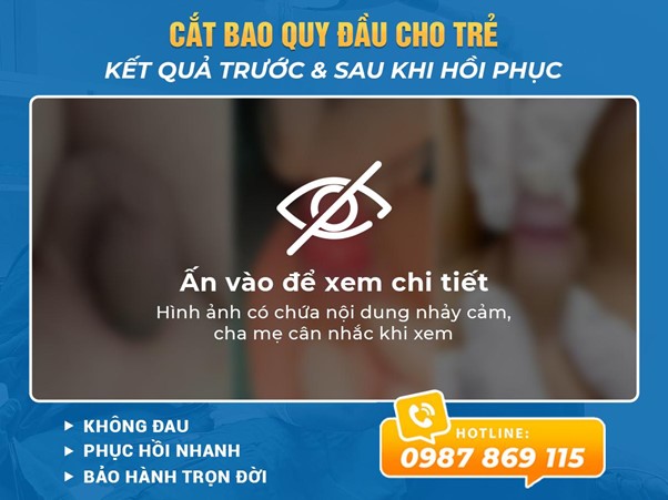 Kết quả trước & sau khi cắt bao quy đầu cho trẻ
