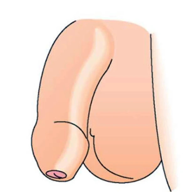 Ảnh minh họa bao quy đầu dài