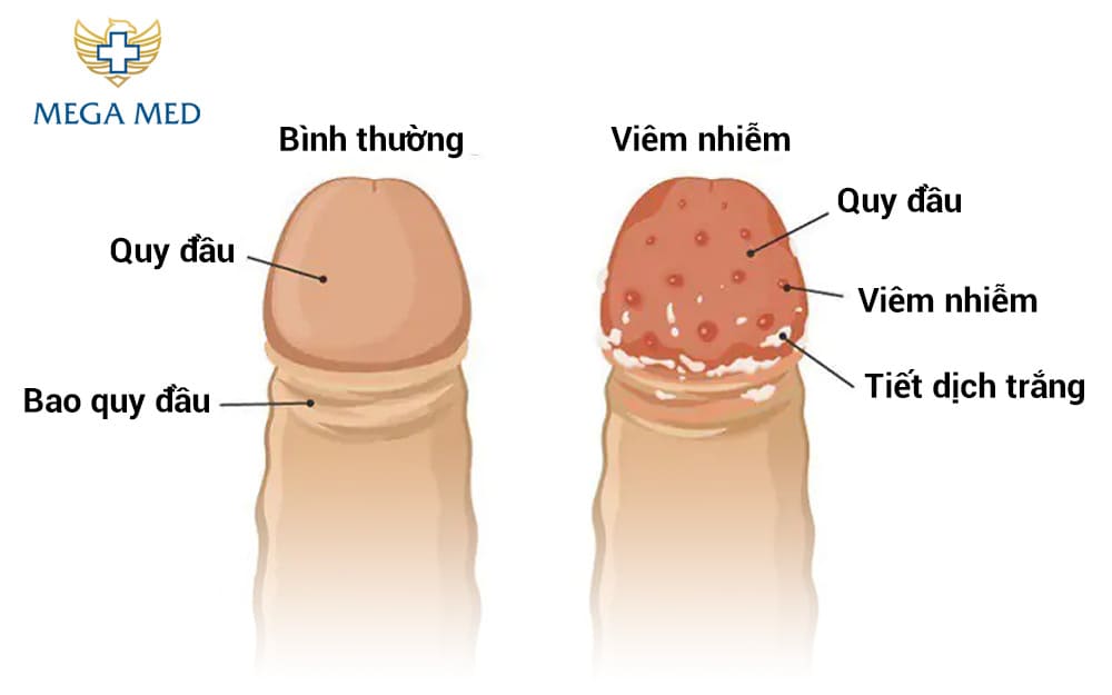 Cách điều trị ngứa da quy đầu