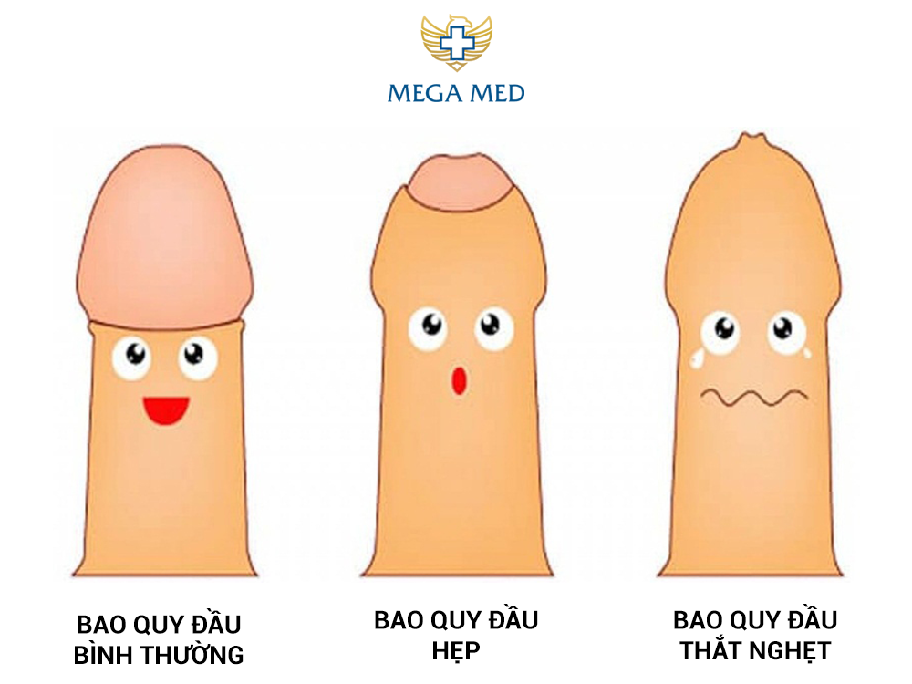 bao quy đầu bị hẹp