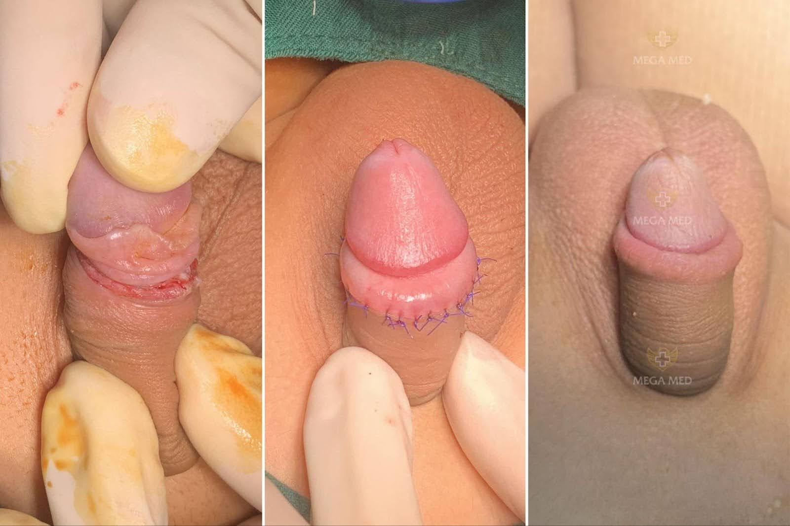 hình ảnh trước và sau khi cắt bao quy đầu