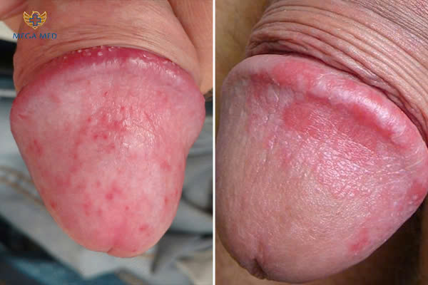 cậu nhỏ nổi mụn có nguy hiểm không