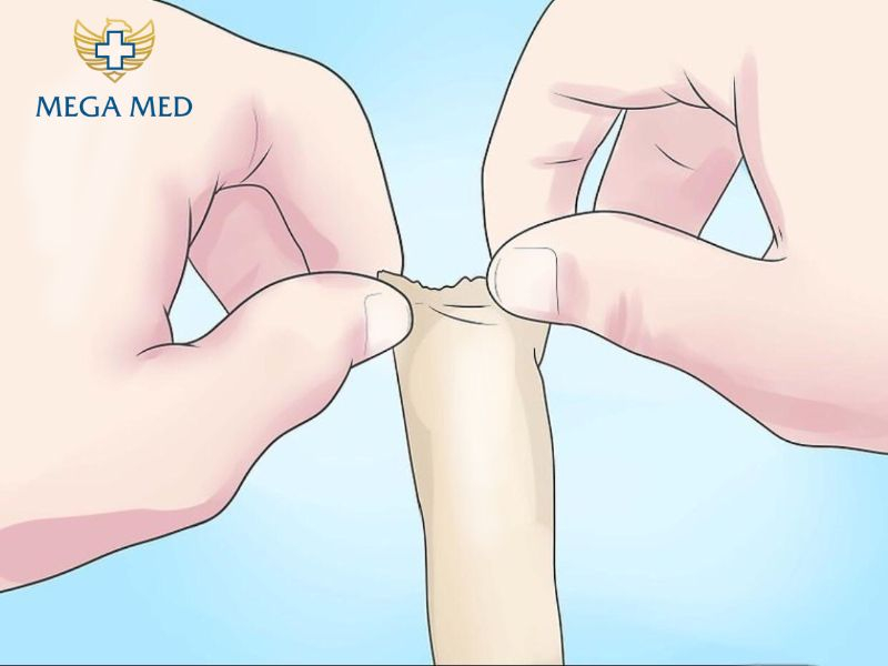 Dấu hiệu cho thấy trẻ cần cắt bao quy đầu