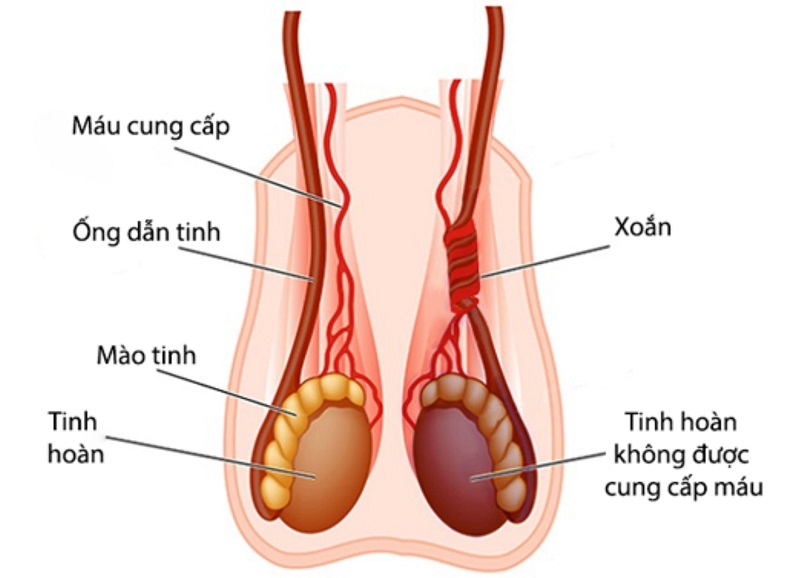 Đau tinh hoàn bên phải có thể do nhiều nguyên nhân gây ra