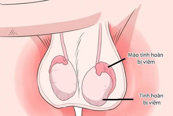 Đau tinh hoàn sau khi quan hệ có thể do nhiều nguyên nhân