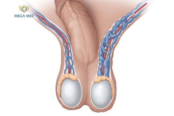 Giãn tĩnh mạch tinh