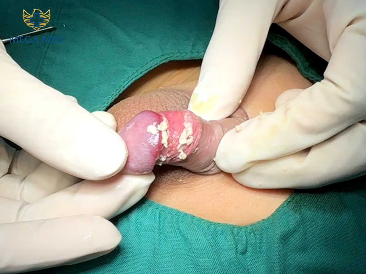 Hẹp bao quy đầu là 1 trong những nguyên nhân khiến dương vật có bựa trắng