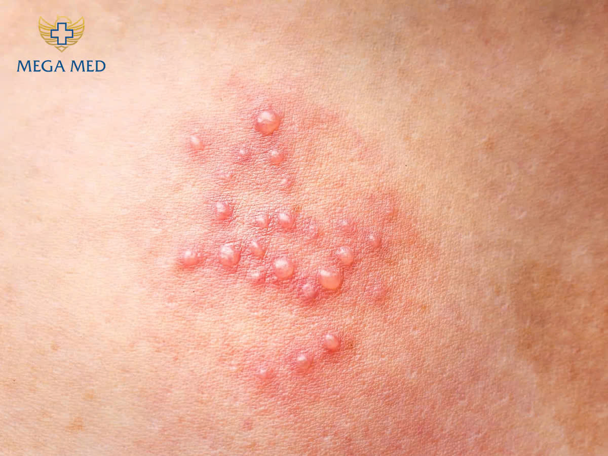 Mụn rộp sinh dục nam bôi thuốc gì?