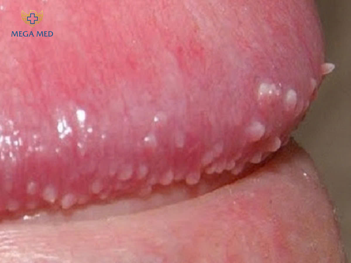 Nổi mụn nhỏ màu trắng ở rãnh bao quy đầu có nguy hiểm không?