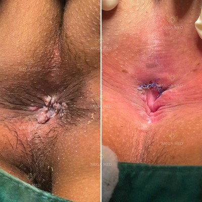 Hình ảnh trước và sau khi điều trị sùi mào gà ở hậu môn