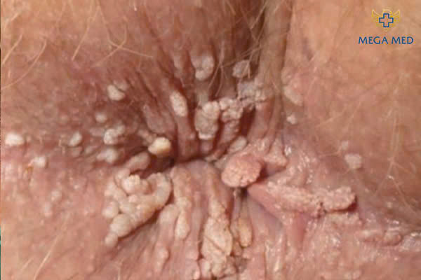 sùi mào gà ở hậu môn