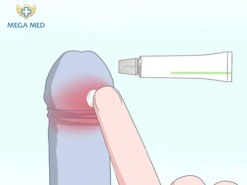 Bôi thuốc điều trị sùi mào gà