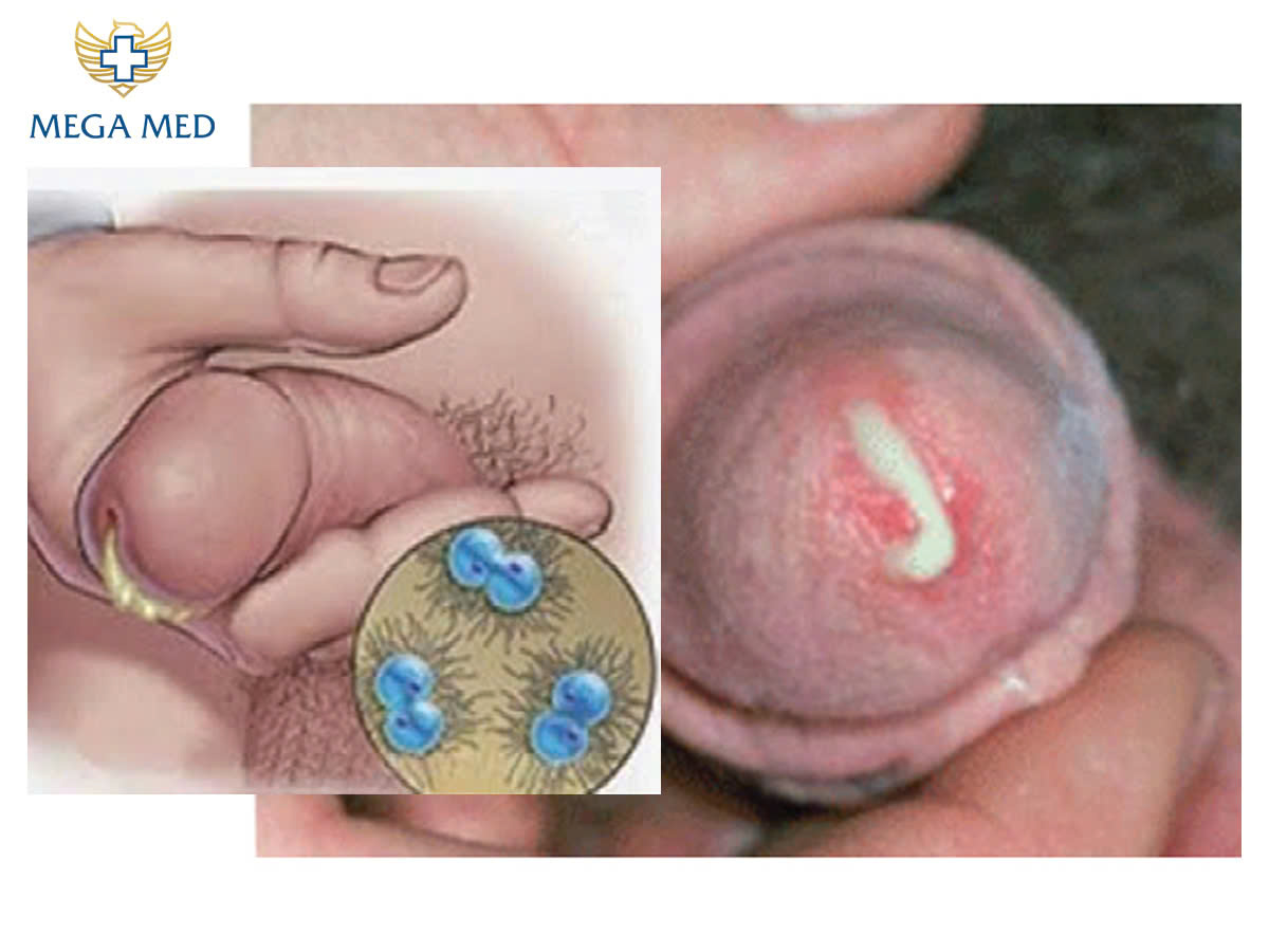 Đi tiểu ra mủ trắng có thể là biểu hiện của bệnh Chlamydia