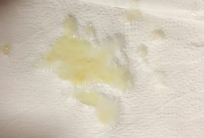 Tinh dịch màu vàng là gì?