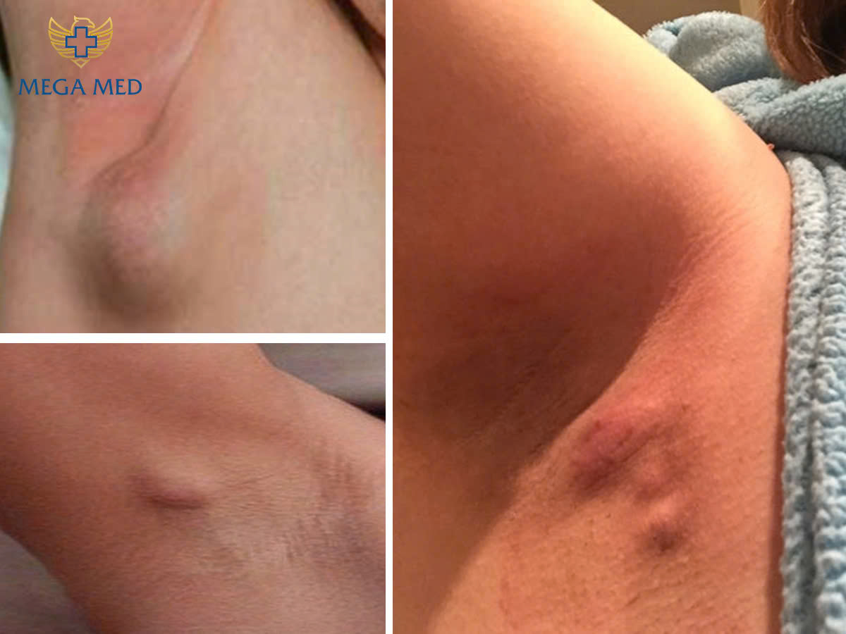 U mỡ ở nách có nguy hiểm không?