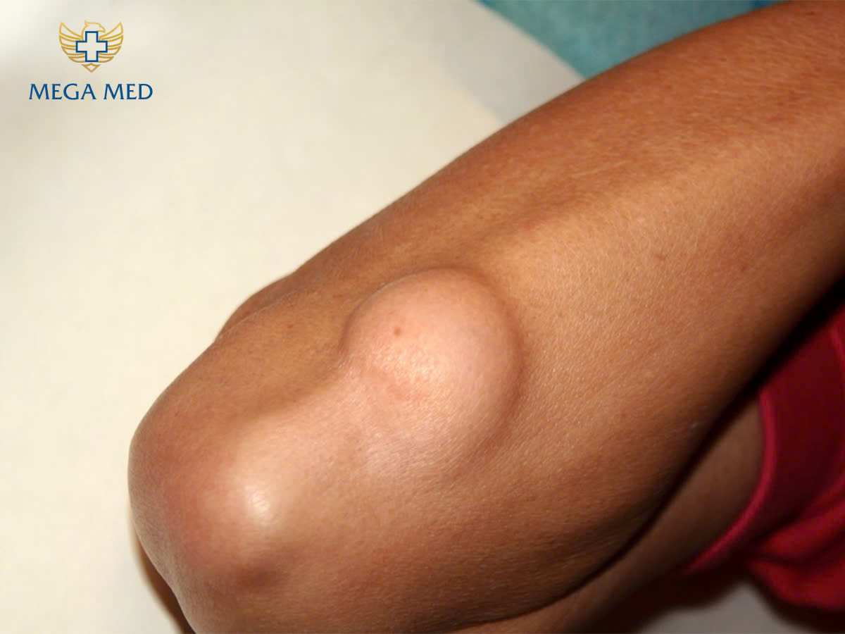 U mỡ bóc đi liệu có bị lại hay không?